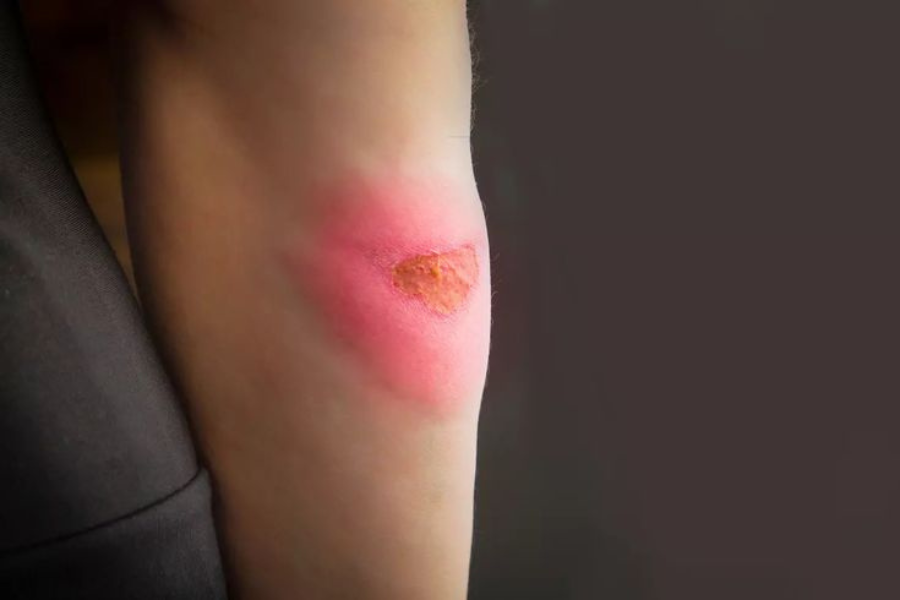 kemerahan dan bengkak yang meluas