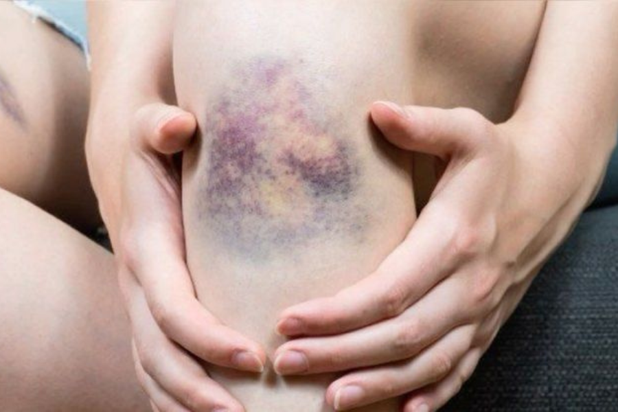 penyebab luka bernanah