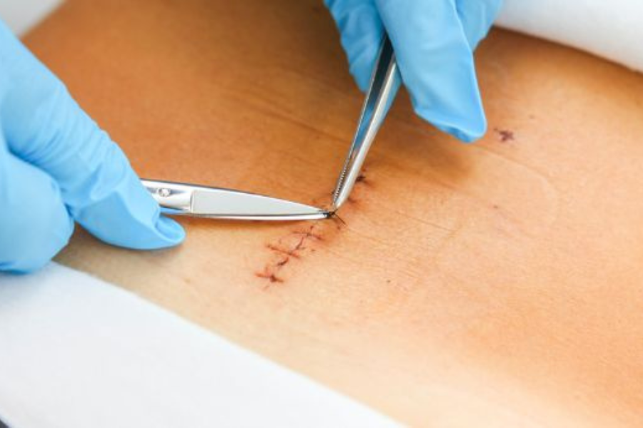 perawatan luka jahitan