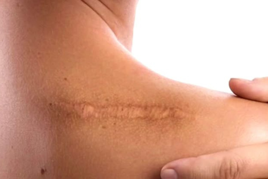 cara mengobati luka yang terlihat dagingnya