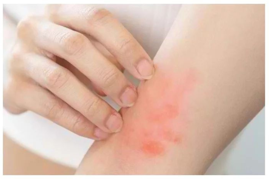 menurunkan risiko infeksi luka