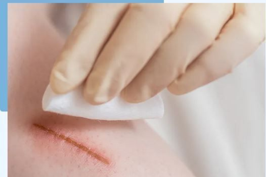 cara merawat luka terbuka agar cepat kering