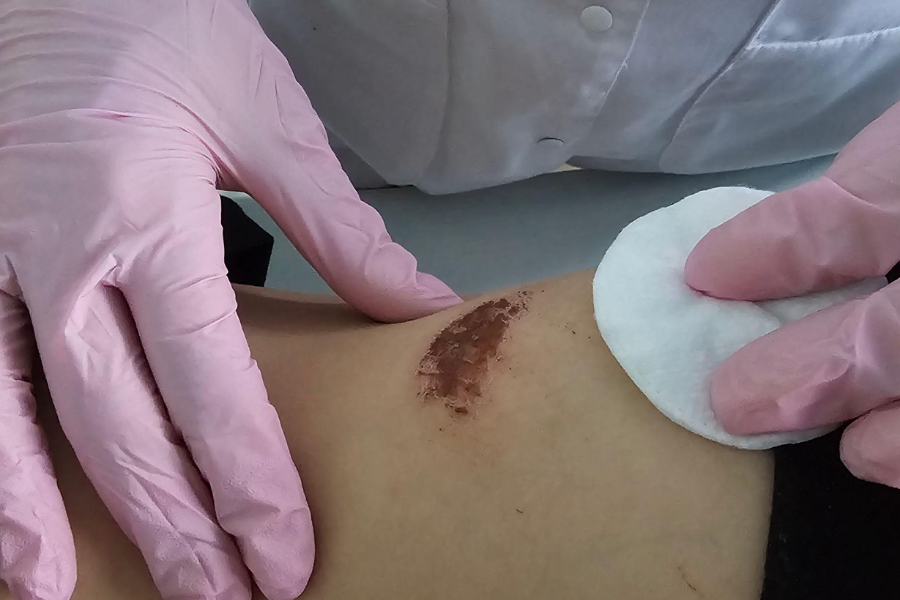 cara mengeluarkan nanah pada luka bengkak